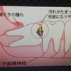 私の疾病と、ほぼ同じ症例の親知らずのイラストです。